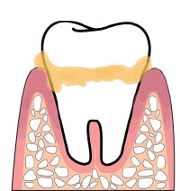 歯周病対策