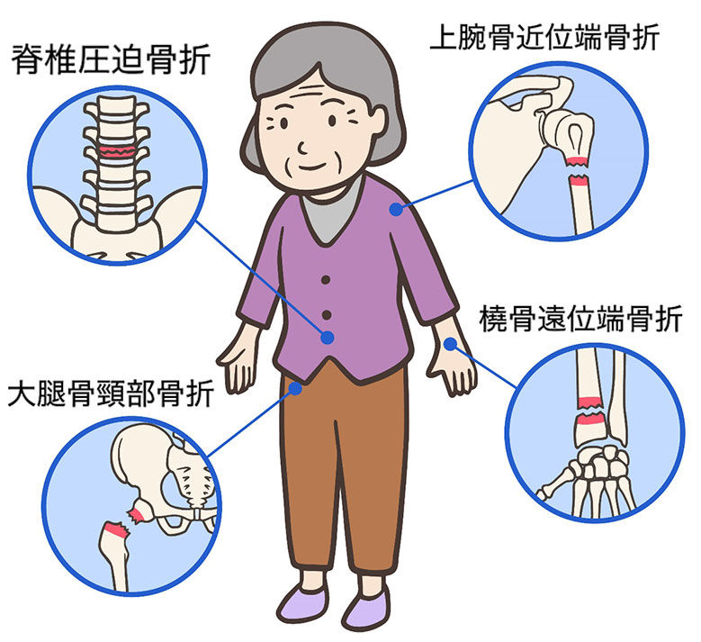 高齢者の骨折予防①高齢者に多い骨折と原因