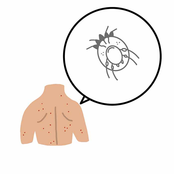 疥癬、かいせん、カイセン、ヒゼンダニ