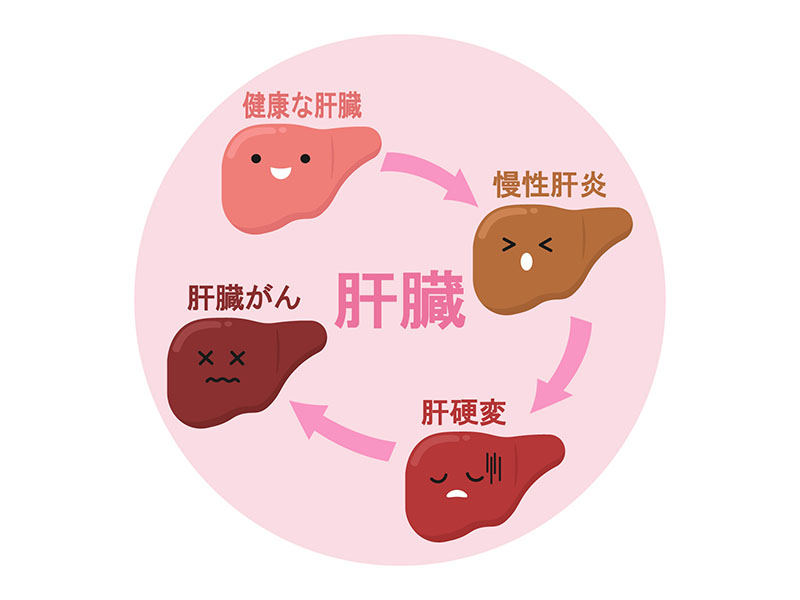 健康な肝臓、肝炎、肝硬変、肝臓がん