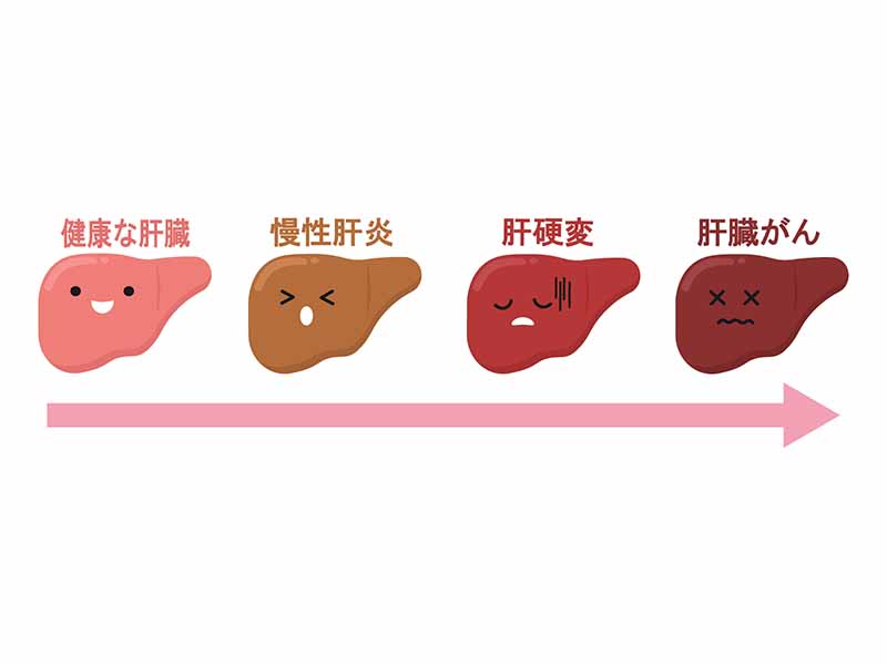 健康な肝臓、慢性肝炎、肝硬変、肝臓がん