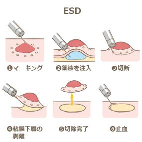 ESD、大腸ポリープの除去方法