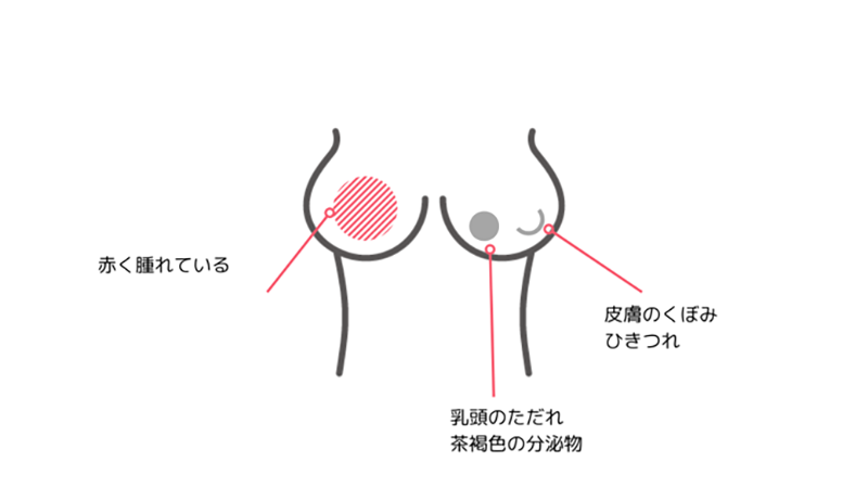 しこり以外の症状