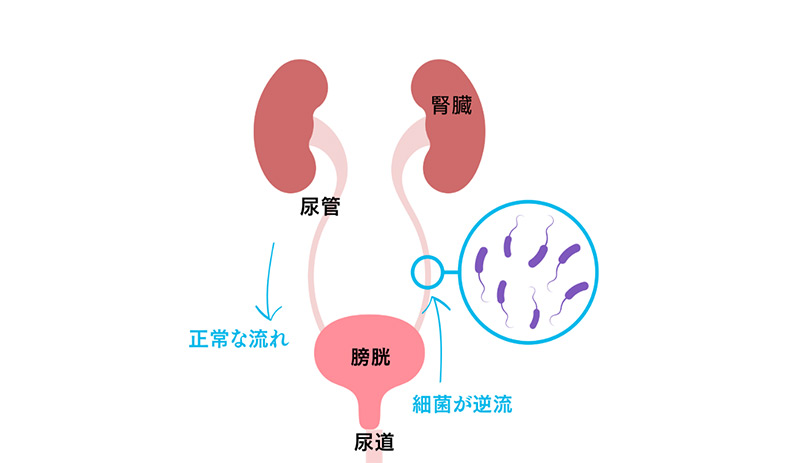 膀胱炎の仕組み