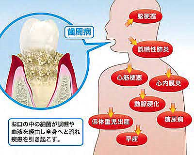 お口の中の細菌が、誤嚥や血液を経由して全身へと流れ疾患を引き起こす