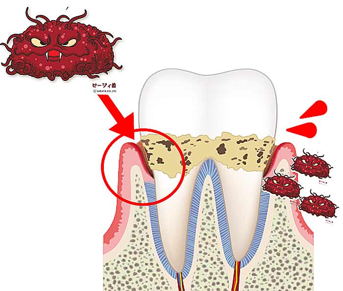 Pg菌への対策は「歯と歯茎をよく磨き歯石を作らないこと」や、Pg菌は酸素に弱いため「歯磨きで歯垢をかき出して酸素に触れる状態を作っておくこと」が大切ですので、日々のハミガキは継続して行いましょう。
