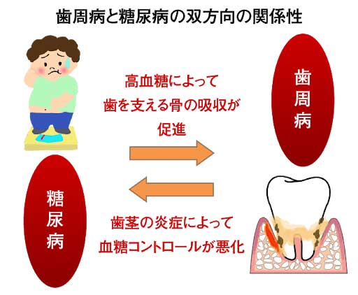 歯周病と糖尿病の双方向の関係性